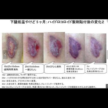 Hisamitsu 久光疤痕修復去疤貼