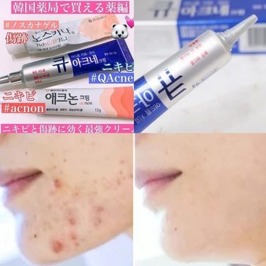 韓國本土藥房熱賣 Q Acne祛痘消炎暗瘡膏15g